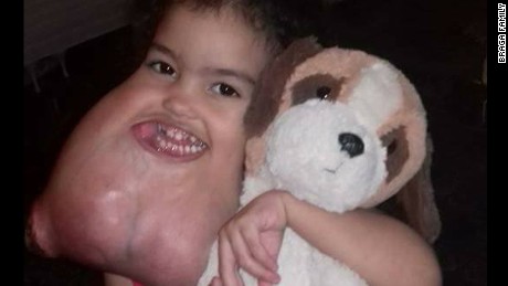 3 Year Old Brazilian Girl Gets Rare Facial Tumor Removed