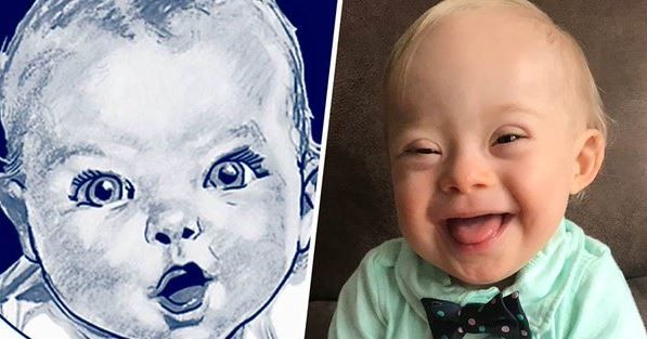 Newest Gerber Baby Has Extra Chromosome and Extra Cute Smile