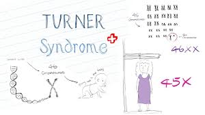 Mosaic Turners Syndrome