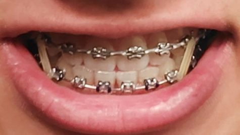 The Pain of Traditional Braces