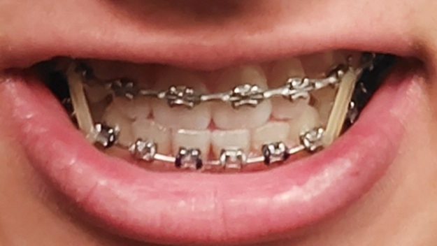 The+Pain+of+Traditional+Braces